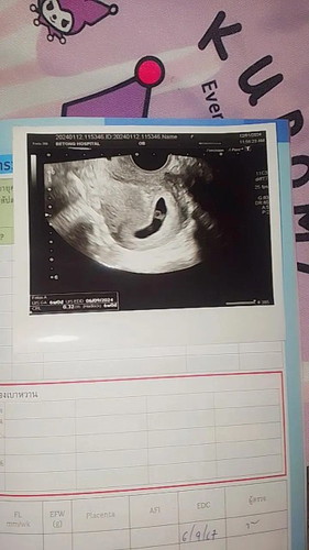 สวัสดีค่ะแม่ๆ วันนี้ไปฝากน้องมา คุณหมอบอก น้อง6week เจอถุงไข่แดงกับหัวใจน้อง แบบนี้จะท้องลมอีกไหมค่ะ