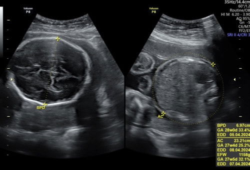 Berat Janin 28 minggu