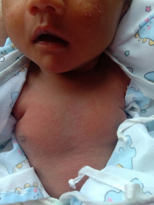 ผื่นแดง ใช้อะไรให้หาย