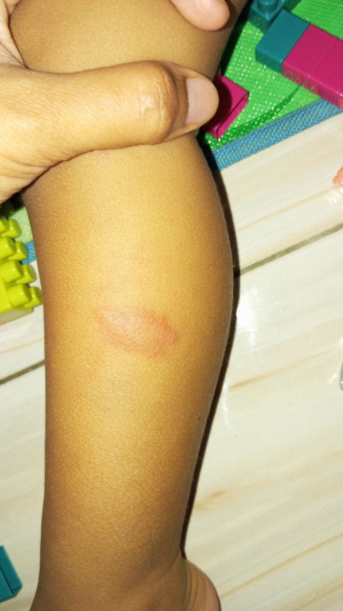 Bercak merah tebal di kaki