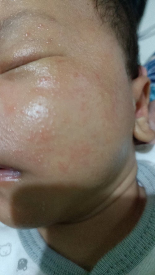 Beruntusan bayi atau alergi?