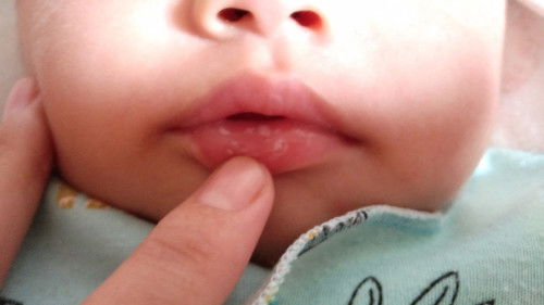 Bercak putih di bibir bayi 2buln+