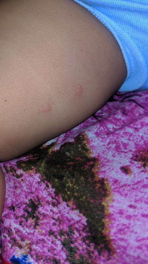 Gatal pada kulit bayi