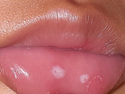 Lidah dan bibir sariawan
