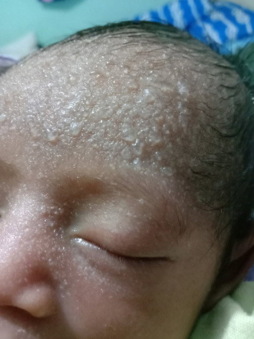Bagaimana cara menghilangkan bruntusan