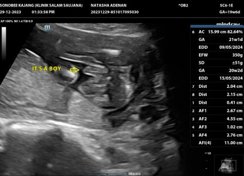 Hai ibu2.. confirm ka baby boy? Sy scan masa 20 week