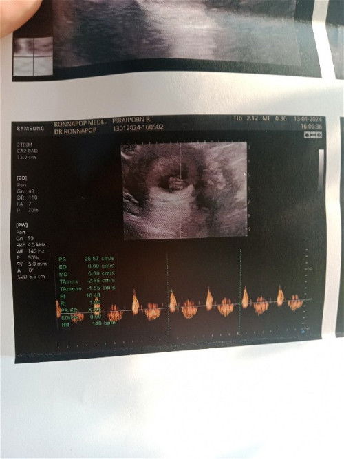 อัลตร้าซาวด์รอบ2 เจอแล้วต้าวมังกรน้อยของแม่