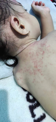 Anak kena tb paru, badannya bintik bintik merah