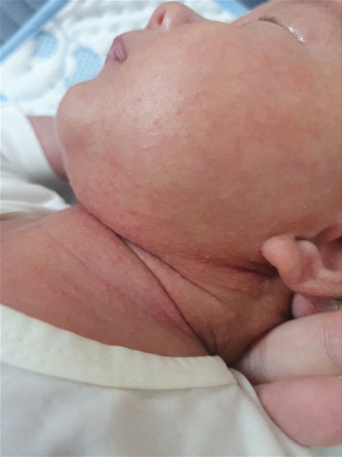 Mẩn đỏ
Dị ứng
Da nhạy cảm