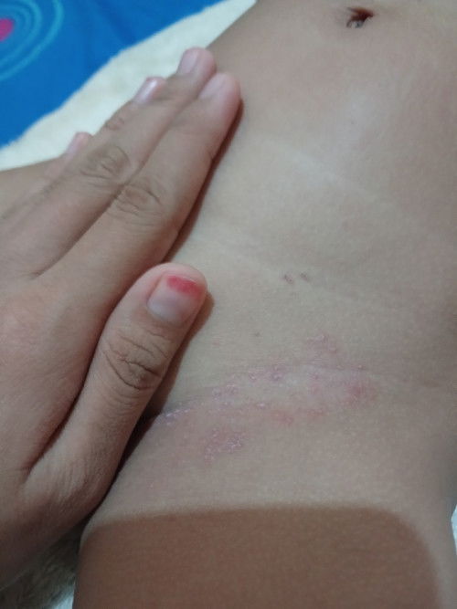 Ini ruam atau bukan ya?