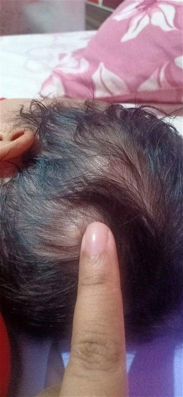 Ada benjolan kecil kalo di pegang bisa bergeser dari umur 2 mingguan udh ad, kira2 ap y bun? Bhyakah