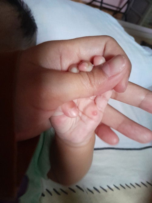 Benjolan seperti bisul