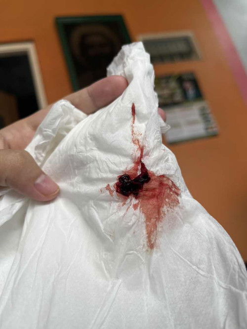 Pendarahan setelah HB usia 30w