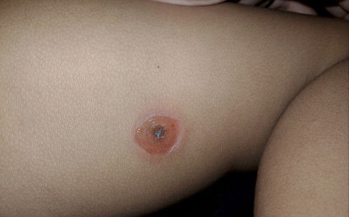 Kulit anak melempuh jadi koreng