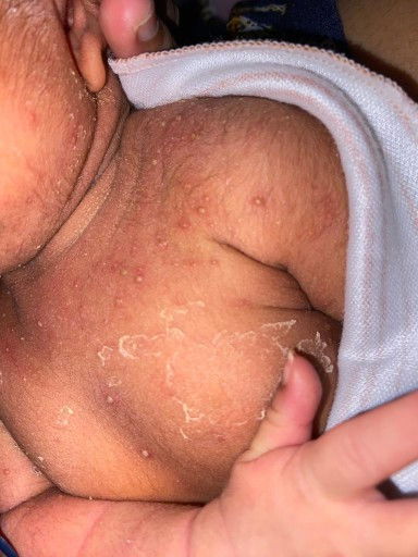 Mau tanya dong penyebabnya bintik bernanah  kek difoto apa yah? Cara mengatasinya gimana?.