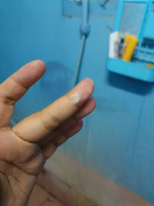 ตกขาวสีขาวขุ่นเป็นวุ้นๆ