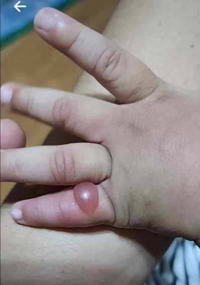 Lumolobo sa daliri ni baby