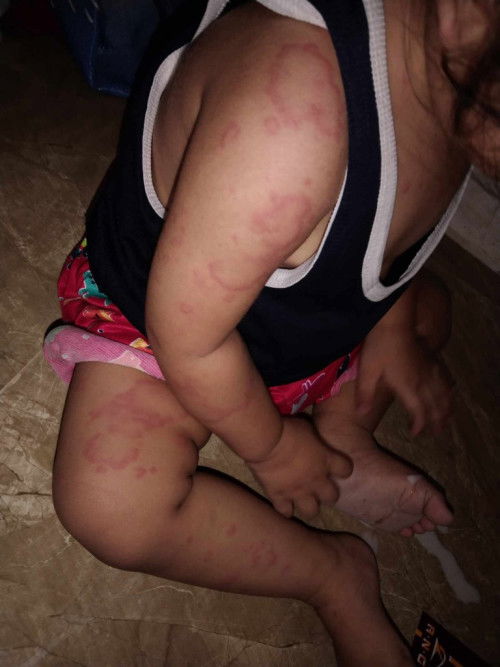 May pulapula n lumalabas sa baby namen