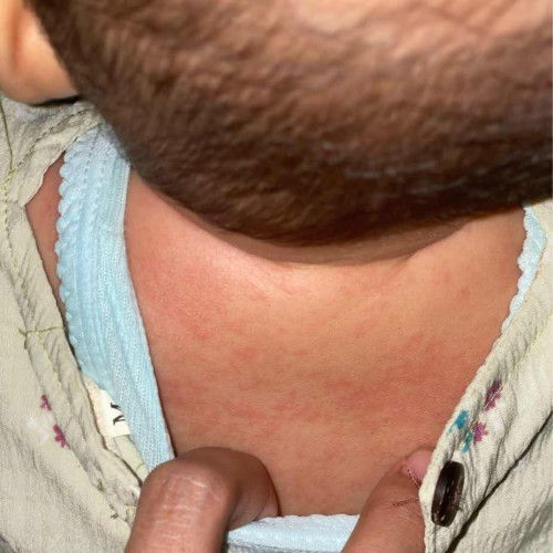 Alergi obat kulit biduran merah-merah