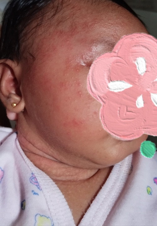 Banyak bintik2 merah di muka bayi 1 bulan