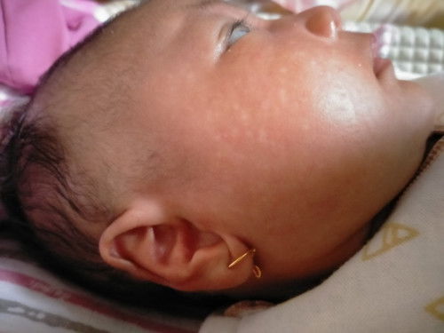 BERCAK PUTIH DIMUKA BAYI