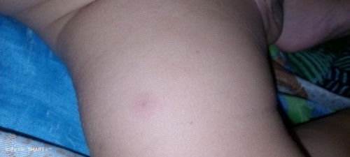 ขอสอบถามเกี่ยวกับอาการหลังฉีดวัคซีนลูกหน่อยค่ะ