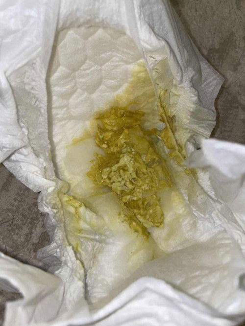 Najis baby 5 bulan berketul mcm ni