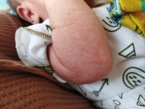 RUAM MERAH PADA BAYI