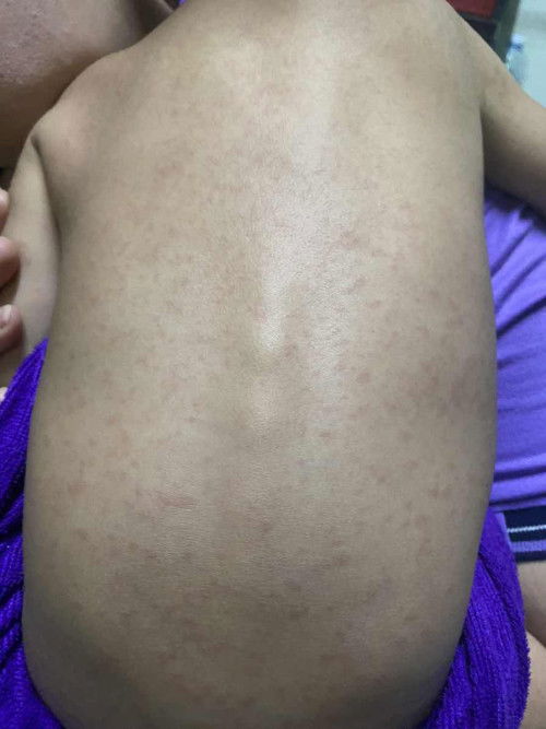 สอบถามผู้รู้เกี่ยวกับโรคหัดค่ะ