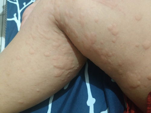 Alergi setelah 40 hari melahirkan