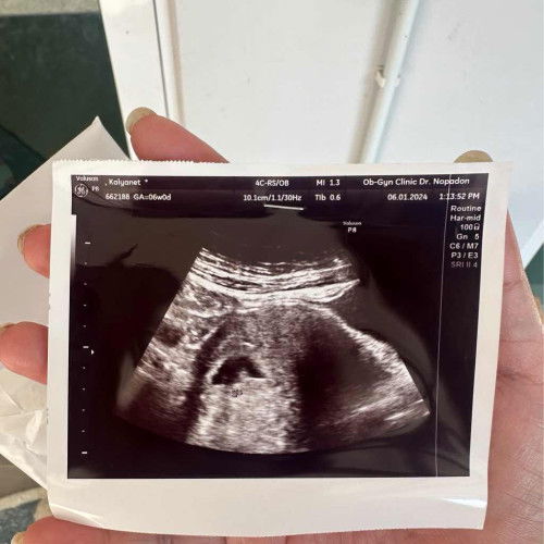 6w เจอถุงการตั้งครรภ์