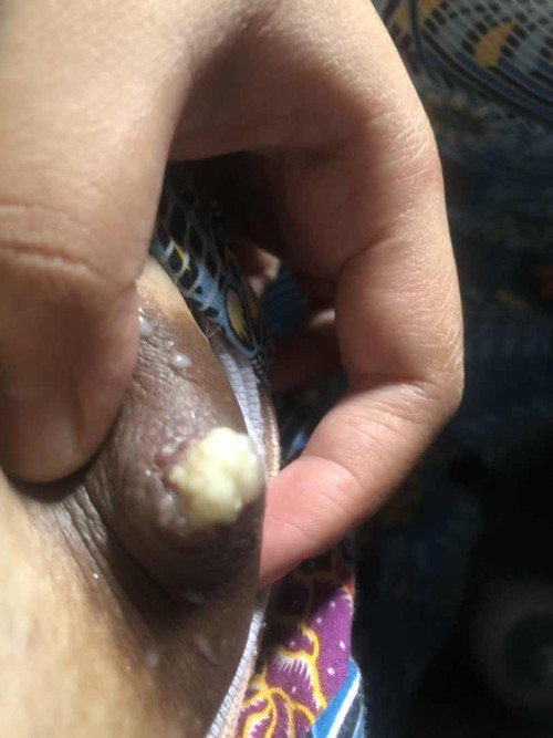 Puting bengkak dan berubah warna