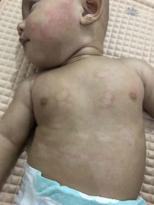 Merah2 di pipi dan di perut