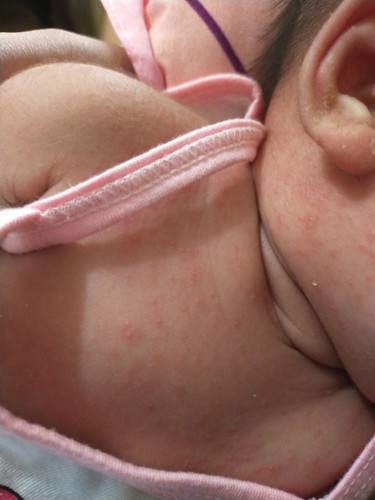 Rashes/Sensitive skin of newborn