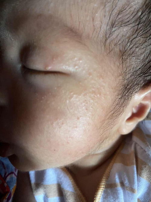 Merah merah usia 15 hari