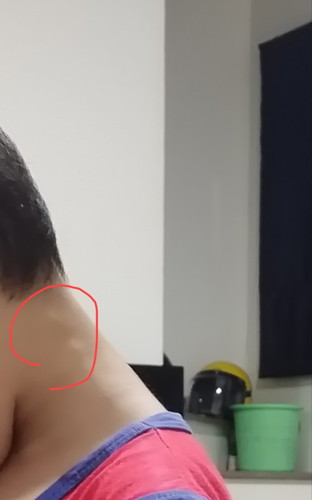 ลูกบ้านไหนมีก้อนขึ้นที่คอแบบน้องไหมคะ มี2ข้างเลยกดไม่เจ็บ ก้อนไม่ยุบเลย