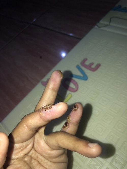 sangat sakit hingga susah mengurus anak