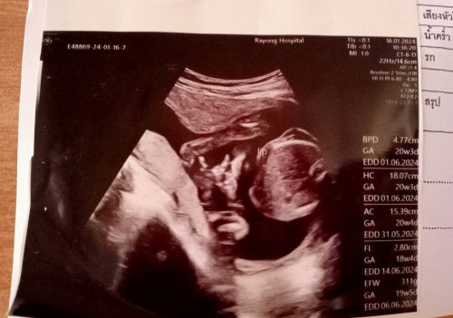 20wยังไม่รู้เพศลูก