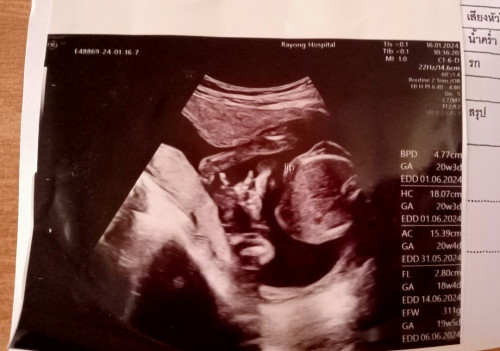 20wยังไม่รู้เพศลูก