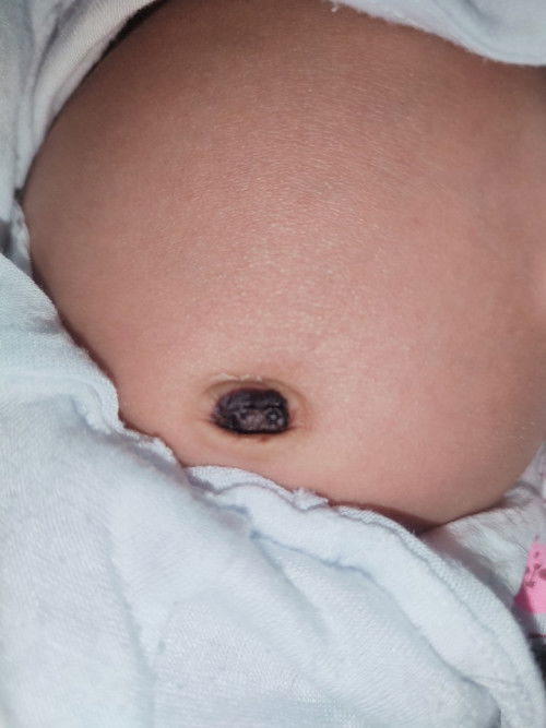 matatanggal pa ba to nag woworry kase ako, 2 weeks old po si baby ko