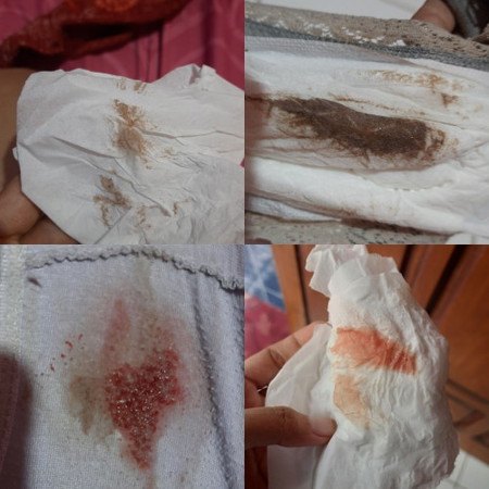 Ijin undur dari grup bun. Saya di diagnosa hamil BO pada usia 8w. Kmd di 11w saya flek lalu dikuret