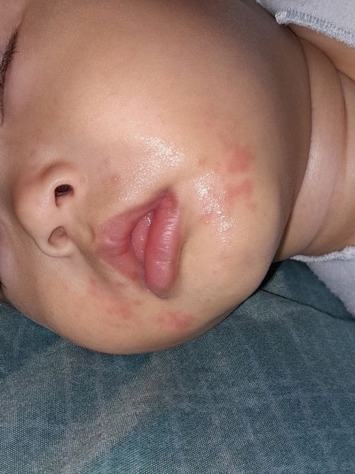 Merah disekitar wajah bayi