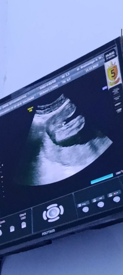 Bund mau tanya ini hasil usg "kelihatanya cowok", apakah nanti bisa berubah?