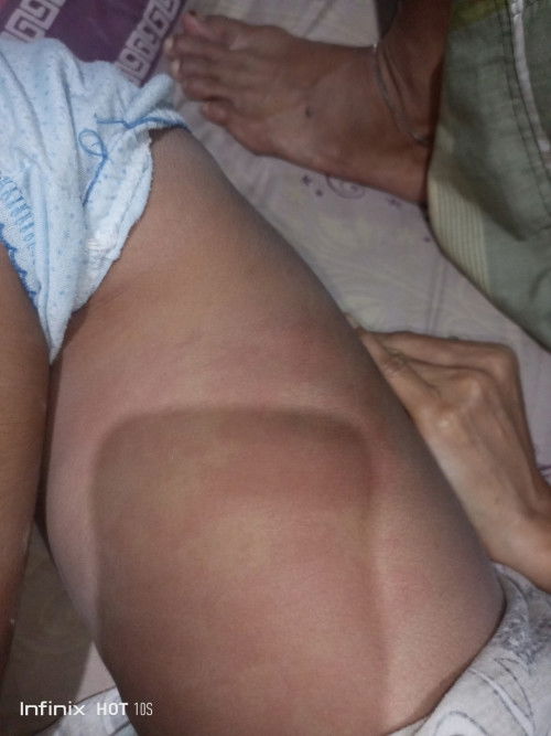 Campak atau Kaligata ?