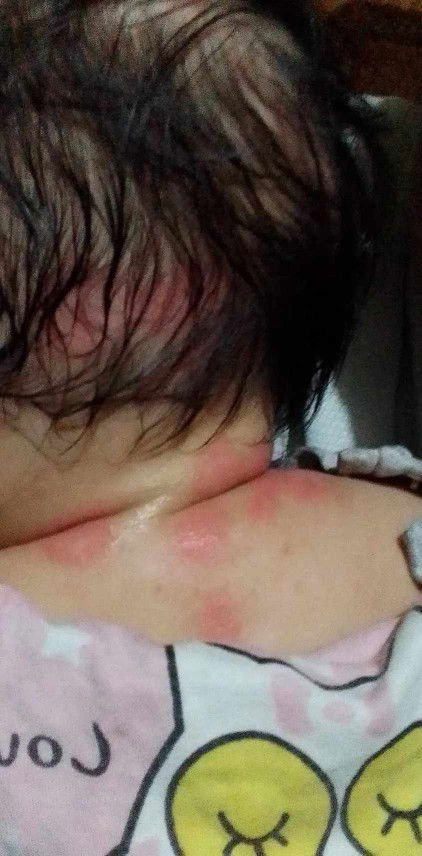 anu po kaya gamot dyan sa tumubo pula2 sa leeg at ulo nang baby ko ?pa help nman po salamat