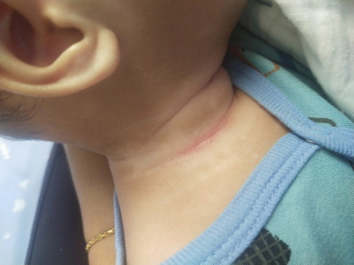 Kesan merah di leher bayi