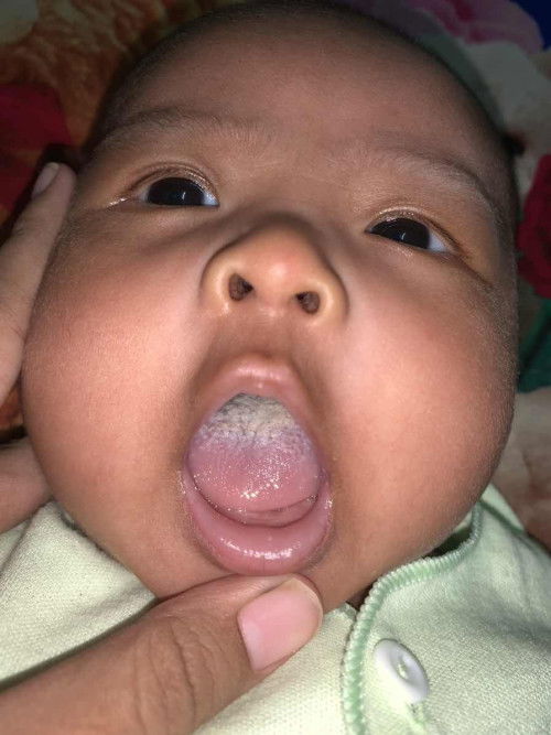 JAMUR di lidah bayi