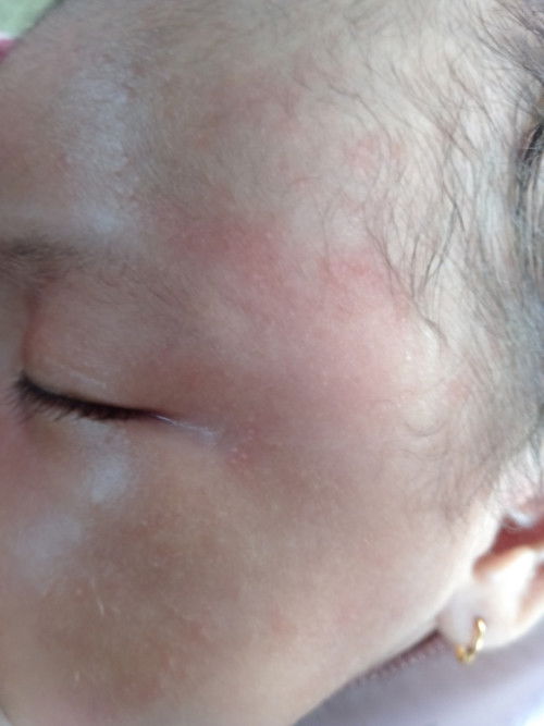 Ini efek kena Asi atau biang keringat bund?