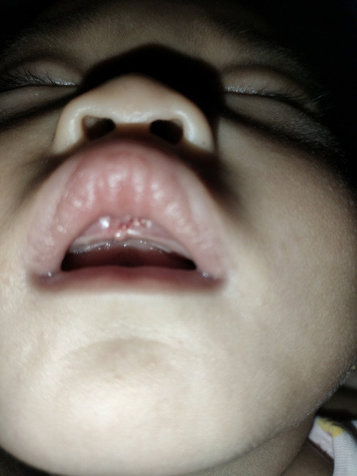 Liptie robek gara gara terbentur