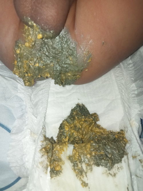 น้องจะ4เดือนแต่ถ่ายเหนียวทำไงดีคะ